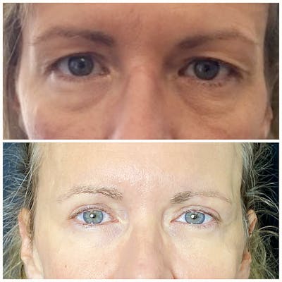 Accutite Before & After Gallery - Patient 8525037 - Image 1