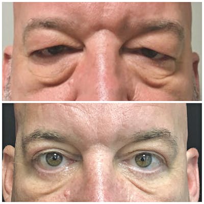 Accutite Before & After Gallery - Patient 8525039 - Image 1