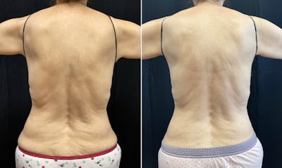 Bodyfx Radiofrequency Before & After Gallery - Patient 8525045 - Image 1