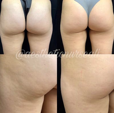 Bodyfx Radiofrequency Gallery - Patient 8525046 - Image 1