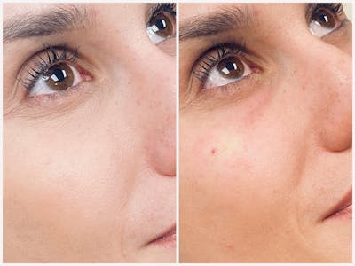 Dermal Fillers Before & After Gallery - Patient 56162628 - Image 1