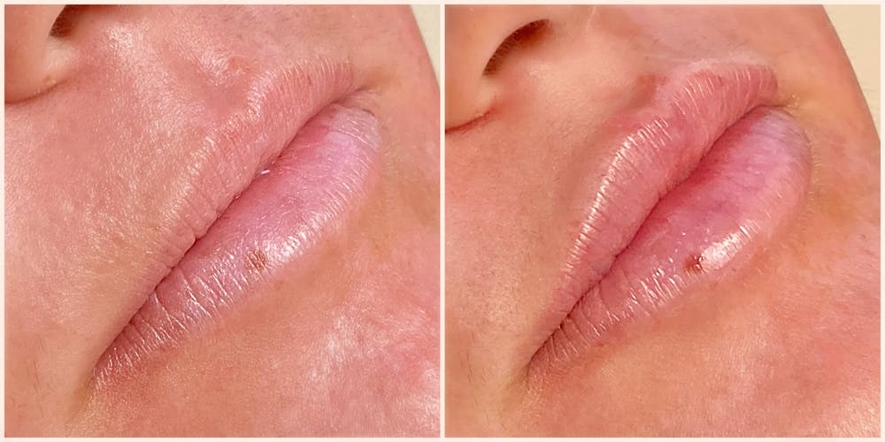 Lip Fillers Before & After Gallery - Patient 8525050 - Image 1
