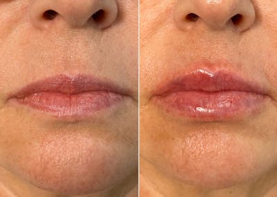 Lip Fillers Before & After Gallery - Patient 8525051 - Image 1