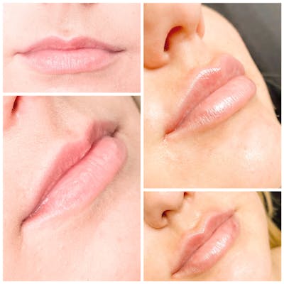 Lip Fillers Before & After Gallery - Patient 8525054 - Image 1