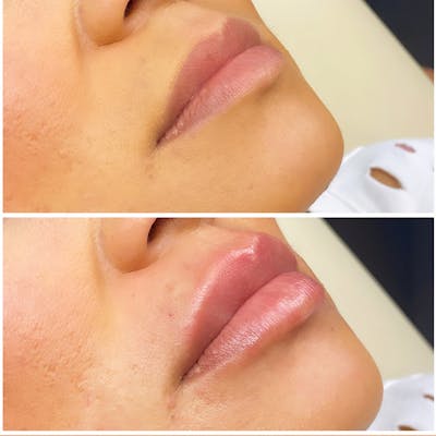 Lip Fillers Before & After Gallery - Patient 8525055 - Image 1