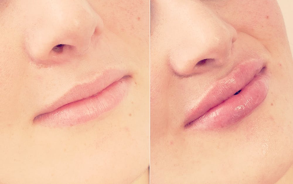 Lip Fillers Before & After Gallery - Patient 8525057 - Image 1