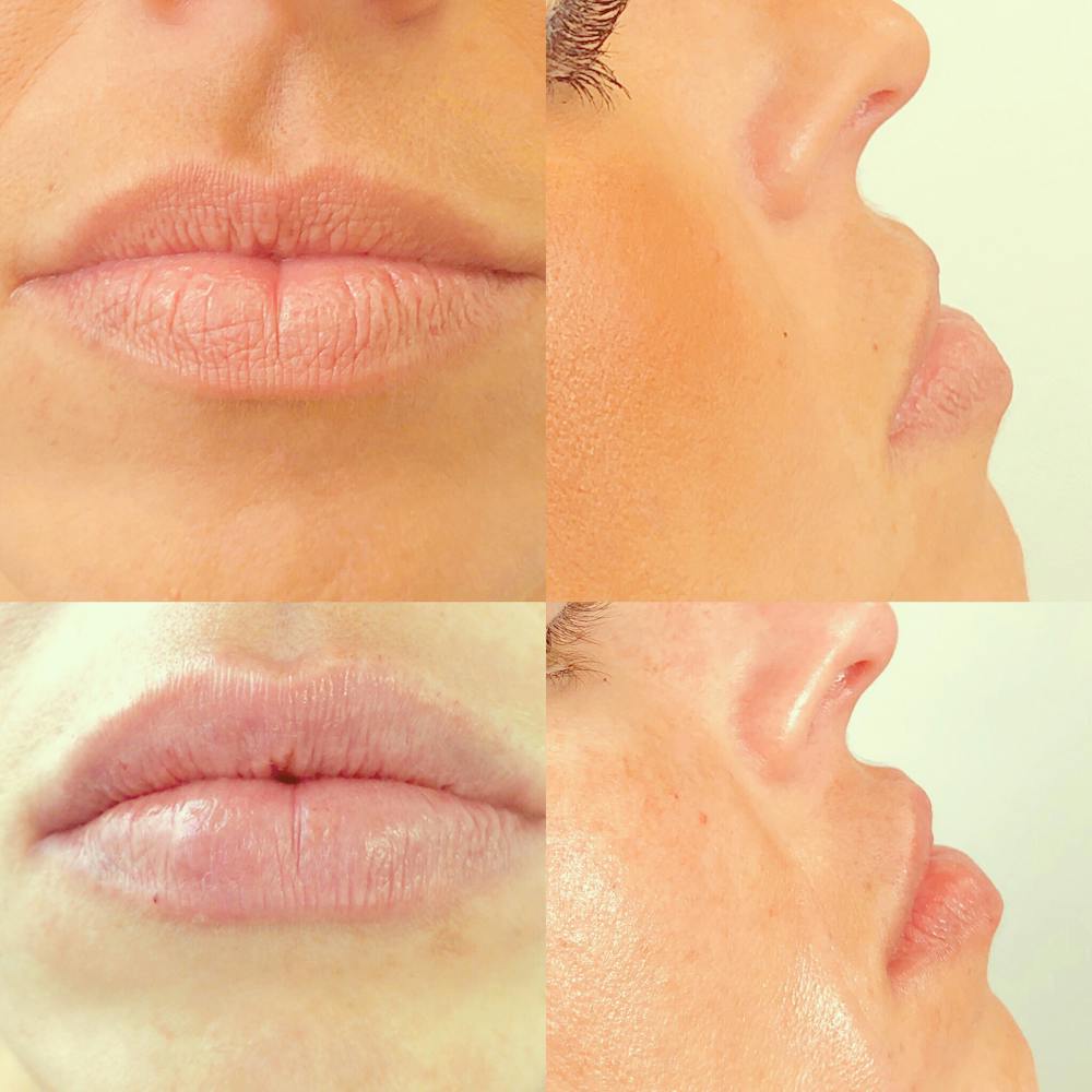 Lip Fillers Before & After Gallery - Patient 8525060 - Image 1