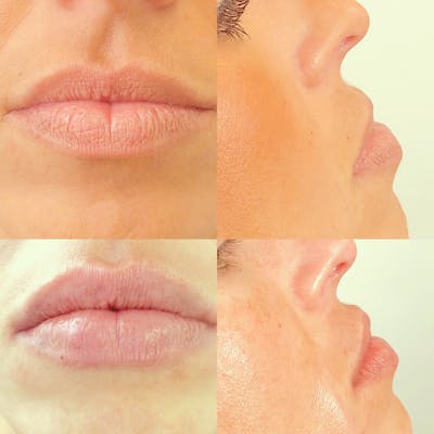 Lip Fillers Before & After Gallery - Patient 8525060 - Image 1