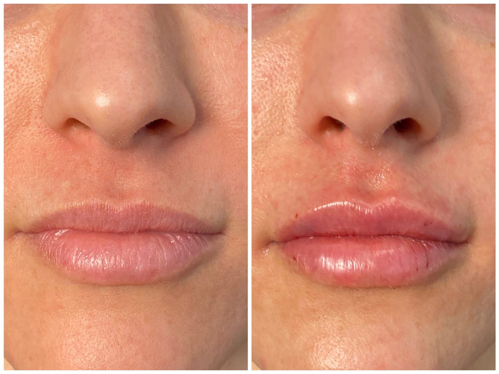Lip Fillers Before & After Gallery - Patient 8525061 - Image 1