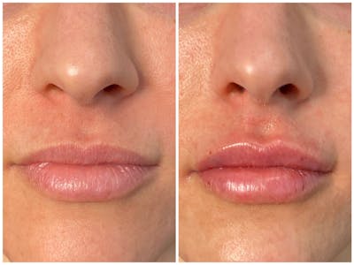 Lip Fillers Before & After Gallery - Patient 8525061 - Image 1