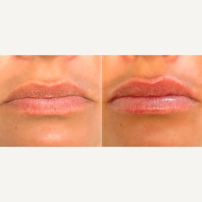 Lip Fillers Before & After Gallery - Patient 8525062 - Image 1