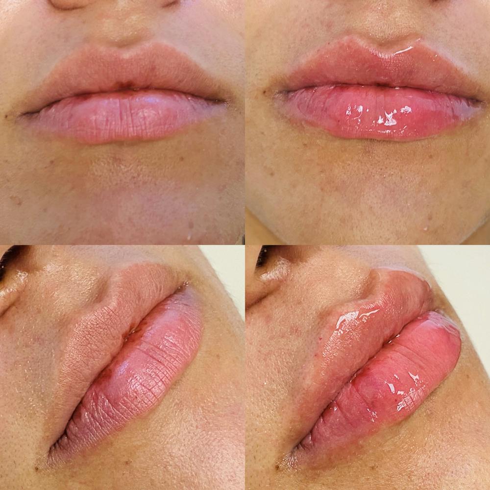 Austin Lip Augmentation - Lip Injections & Implants