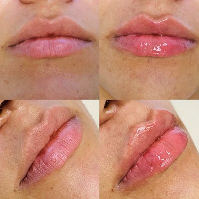 Lip Fillers Before & After Gallery - Patient 8525064 - Image 1