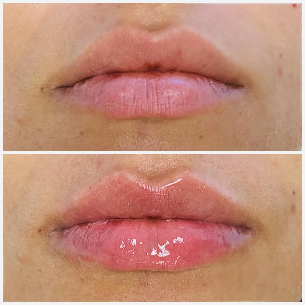 Lip Fillers Before & After Gallery - Patient 8525064 - Image 2
