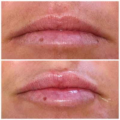 Lip Fillers Before & After Gallery - Patient 8525065 - Image 1