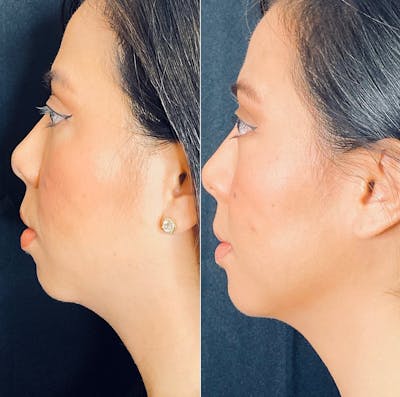 Dermal Fillers Before & After Gallery - Patient 56162790 - Image 1