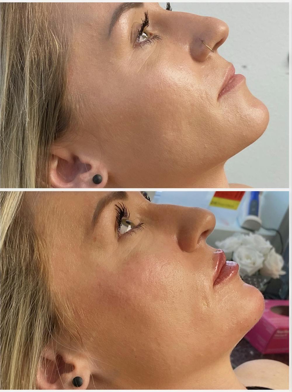 Dermal Fillers Before & After Gallery - Patient 56162822 - Image 1