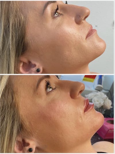 Lip Fillers Before & After Gallery - Patient 8525068 - Image 1