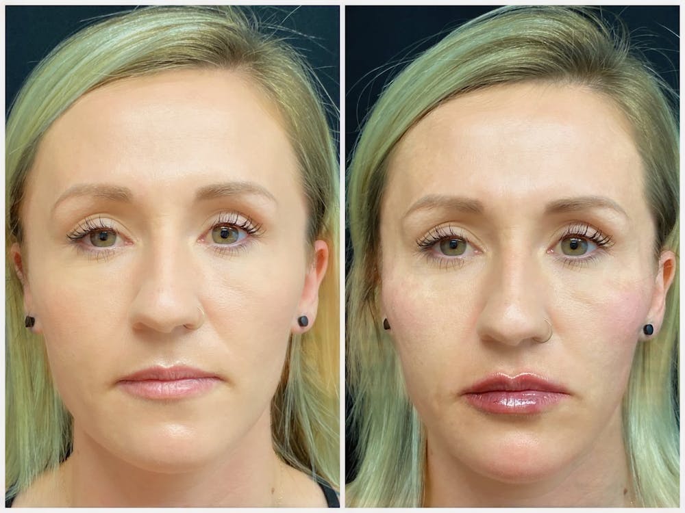 Lip Fillers Before & After Gallery - Patient 8525071 - Image 1