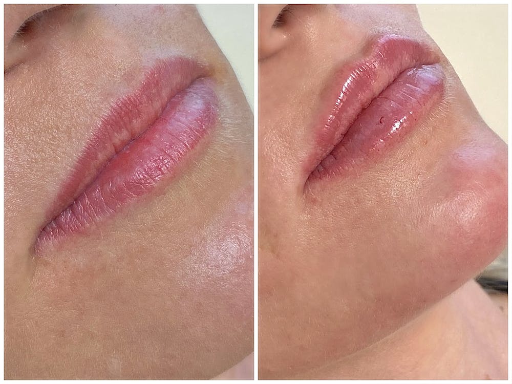 Lip Fillers Before & After Gallery - Patient 8525073 - Image 1