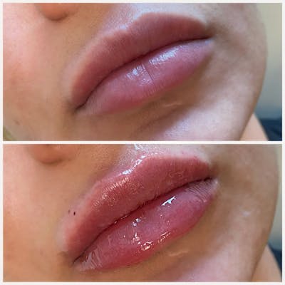 Lip Fillers Before & After Gallery - Patient 8525075 - Image 1