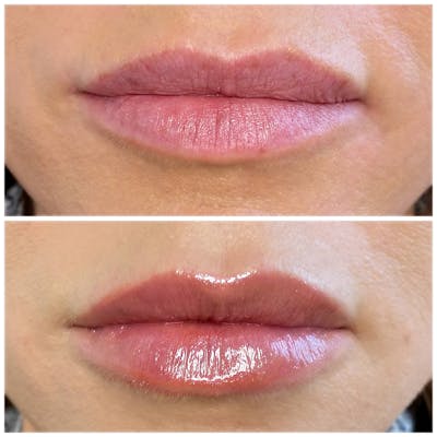 Lip Fillers Before & After Gallery - Patient 8525076 - Image 1