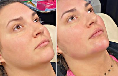 Dermal Fillers Before & After Gallery - Patient 56163055 - Image 1