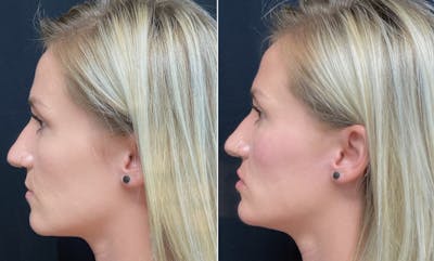 Lip Fillers Before & After Gallery - Patient 8525079 - Image 1