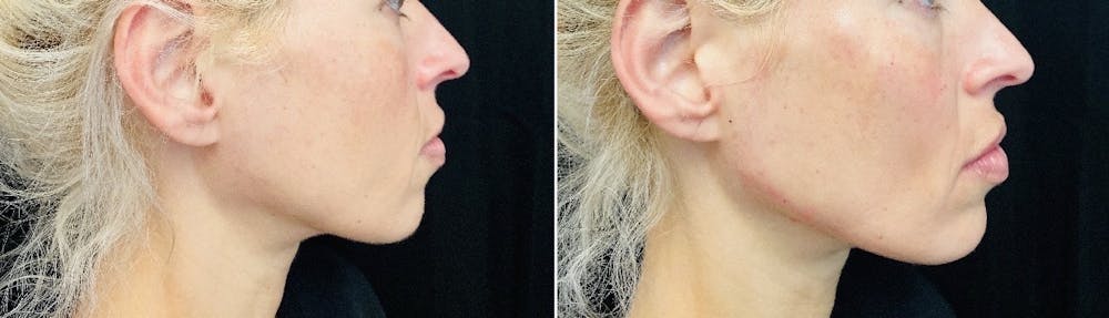 Dermal Fillers Before & After Gallery - Patient 56163112 - Image 2