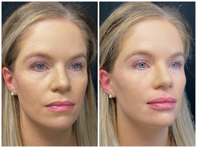Lip Fillers Before & After Gallery - Patient 8525087 - Image 1