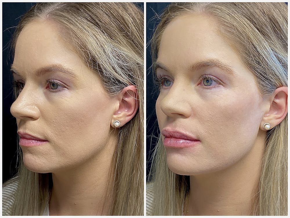 Dermal Fillers Before & After Gallery - Patient 56163179 - Image 2