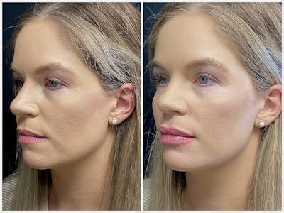Dermal Fillers Before & After Gallery - Patient 56163179 - Image 2