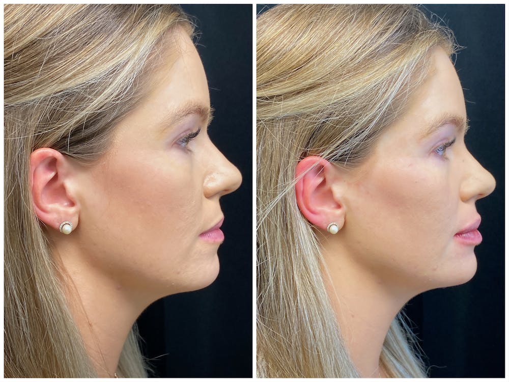 Dermal Fillers Before & After Gallery - Patient 56163179 - Image 3