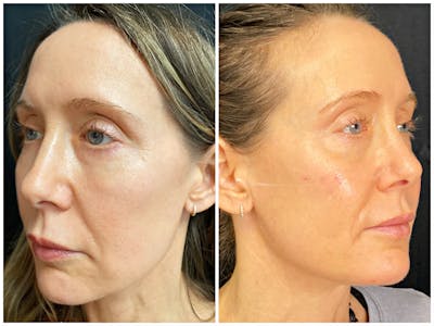 Dermal Fillers Before & After Gallery - Patient 56163201 - Image 1