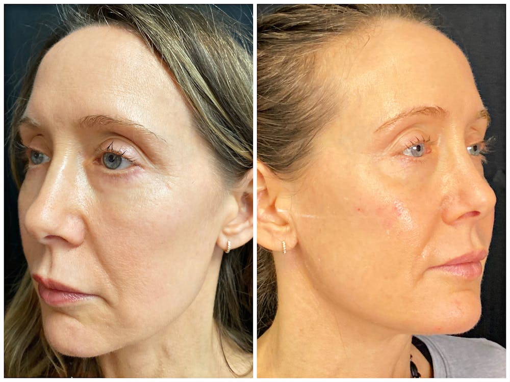 Dermal Fillers Before & After Gallery - Patient 56163201 - Image 1