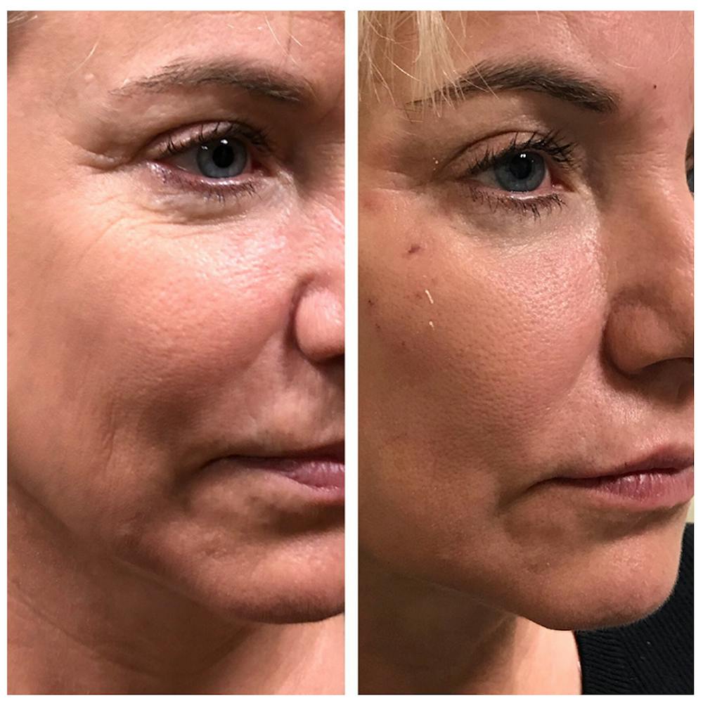 Dermal Fillers Before & After Gallery - Patient 56163224 - Image 1