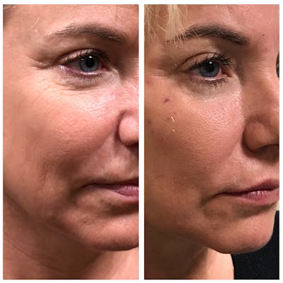 Dermal Fillers Before & After Gallery - Patient 56163224 - Image 1