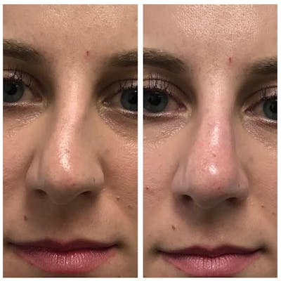 Dermal Fillers Before & After Gallery - Patient 56163225 - Image 1