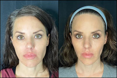 Evoke Radiofrequency Before & After Gallery - Patient 8525130 - Image 1