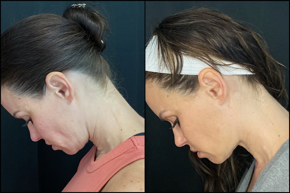 Evoke Radiofrequency Before & After Gallery - Patient 8525130 - Image 2