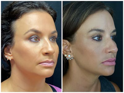 Evoke Radiofrequency Before & After Gallery - Patient 8525134 - Image 1