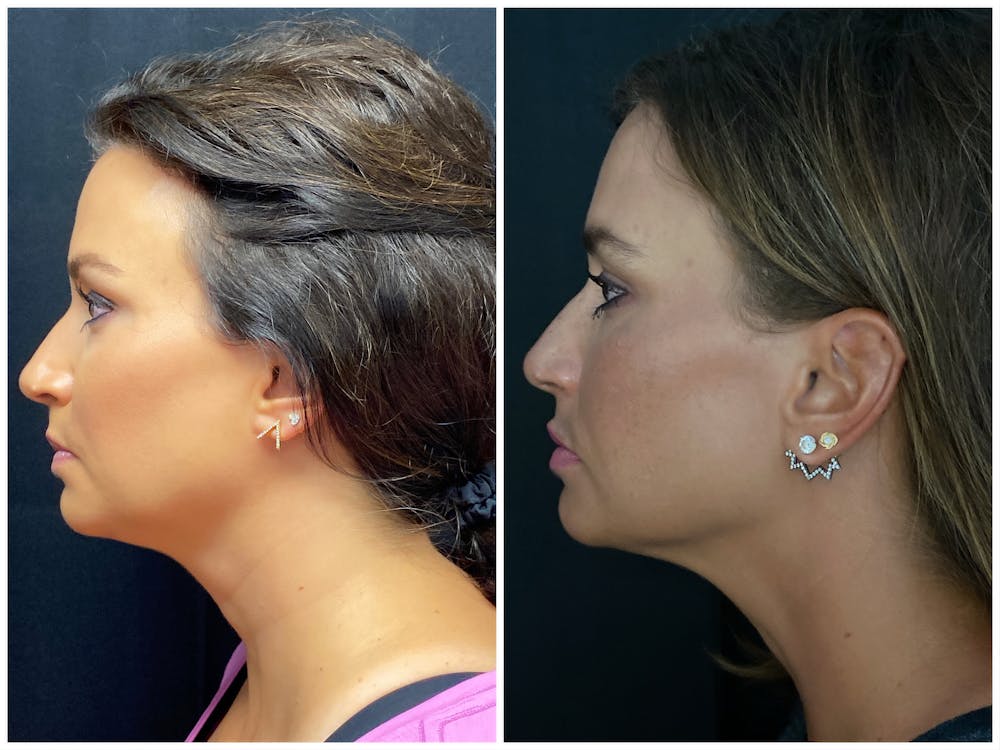 Evoke Radiofrequency Before & After Gallery - Patient 8525134 - Image 2