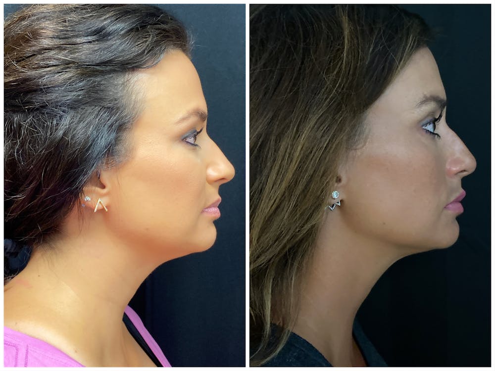 Evoke Radiofrequency Before & After Gallery - Patient 8525134 - Image 3