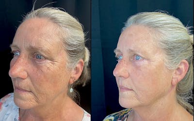 Morpheus8 Before & After Gallery - Patient 8525142 - Image 1