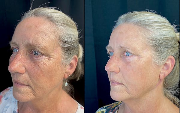 Morpheus8 Before & After Gallery - Patient 8525142 - Image 1
