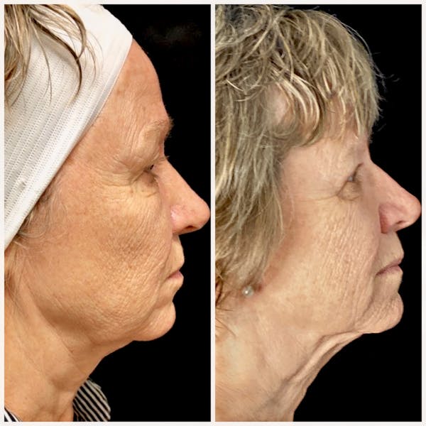 Morpheus8 Before & After Gallery - Patient 8525144 - Image 1