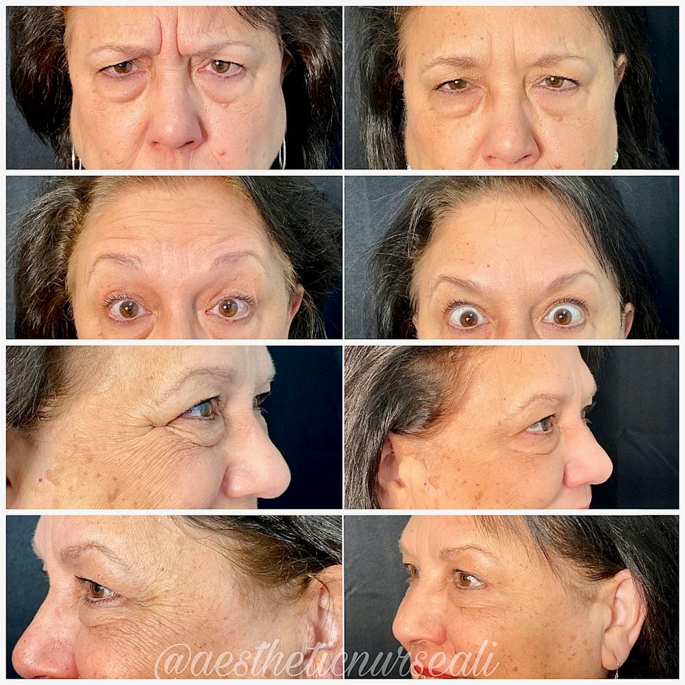 BOTOX Before & After Gallery - Patient 8525147 - Image 1