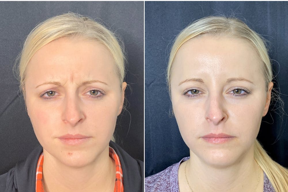 BOTOX Before & After Gallery - Patient 8525148 - Image 1