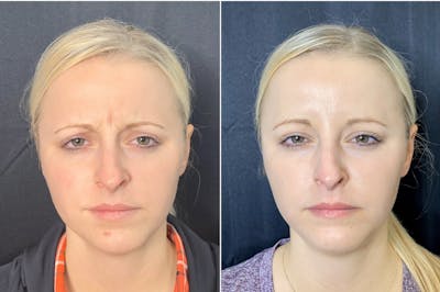 BOTOX Before & After Gallery - Patient 8525148 - Image 1