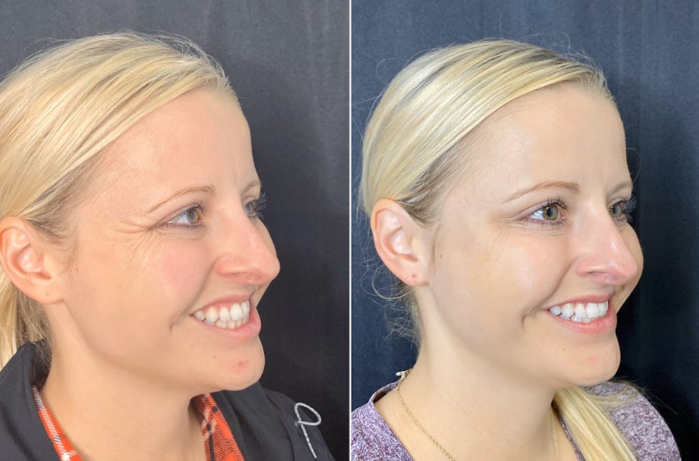 BOTOX Before & After Gallery - Patient 8525148 - Image 2